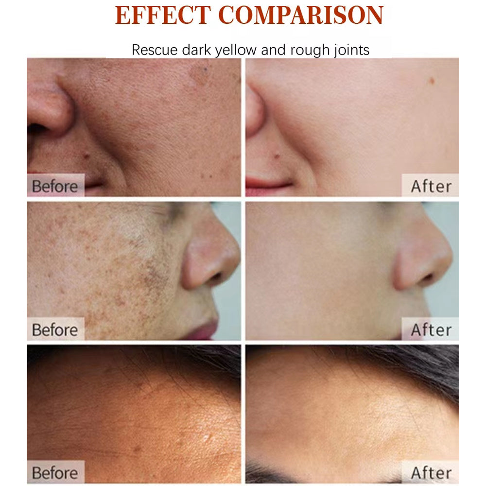 Korean Natural Vegan Neck Facial Vitamin C Acne Pimples Dark Spot Remover